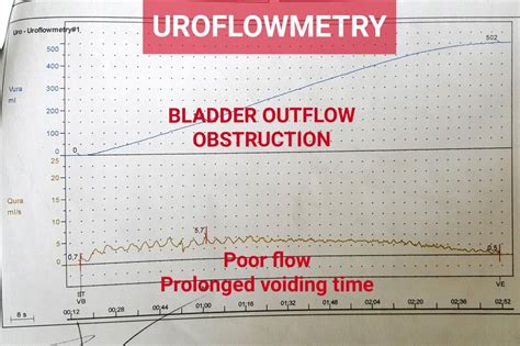 how to read uroflow.